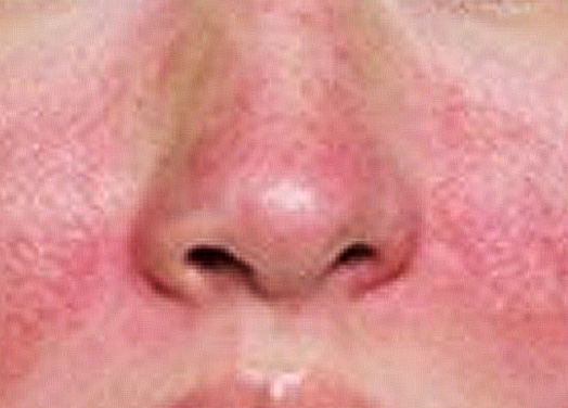 夏日換膚　酒糟性皮膚者應慎選