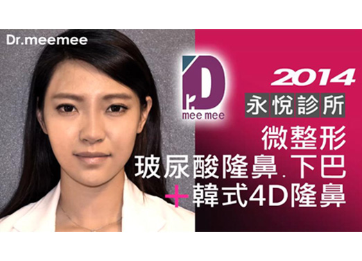玻尿酸4D隆鼻+下巴