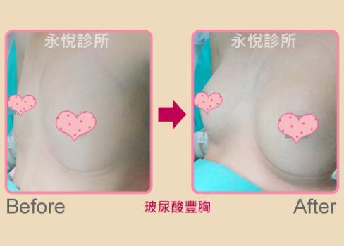玻尿酸豐胸/豐臀