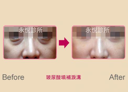 玻尿酸填補淚溝/眼凹