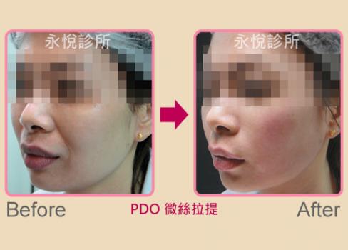 PDO微絲拉提