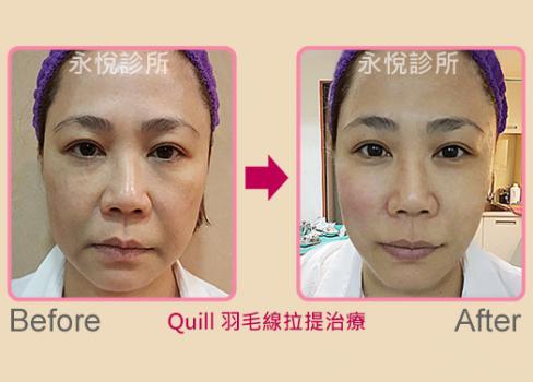 安吉梭羽毛線拉提