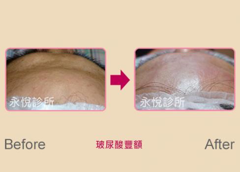 改善額頭凹陷