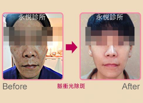 改善黑斑暗沉