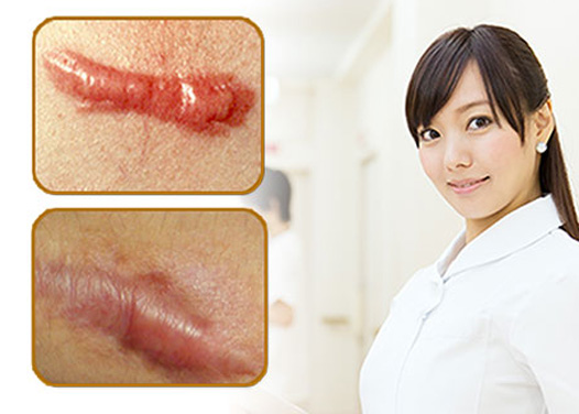 蟹足腫治療