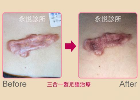 蟹足腫治療案例