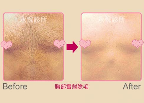 無痛除毛治療案例