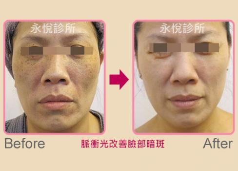 脈衝光治療案例