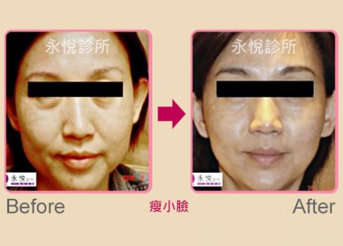 瘦臉/瘦腿/除皺治療